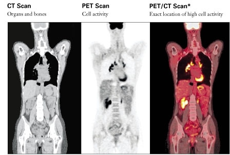 ฟิล์มเอ็กซเรย์จากเครื่องเพทซีทีสแกน - PET/CT (Positron Emission Tomography/Computed Tomography) | ภาพจากเว็บไซต์ UPMC life changing medicine