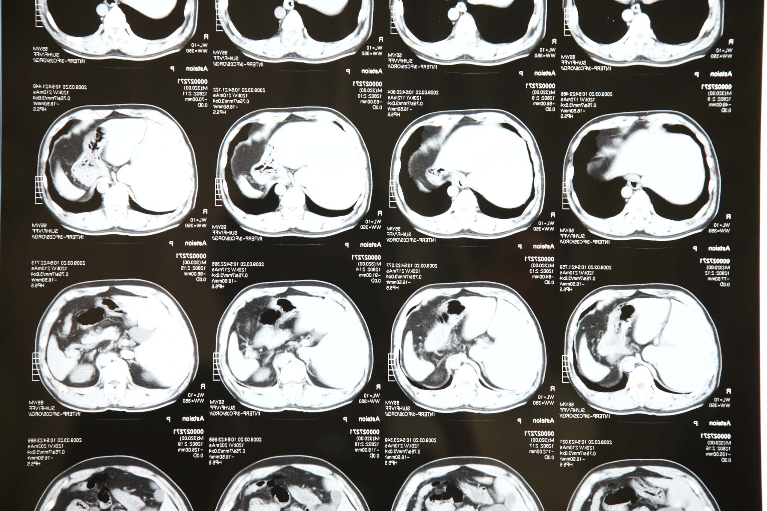 ฟิล์มเอ็กซเรย์จากเครื่องซีทีสแกน – CT Scan (Computerized Tomography)