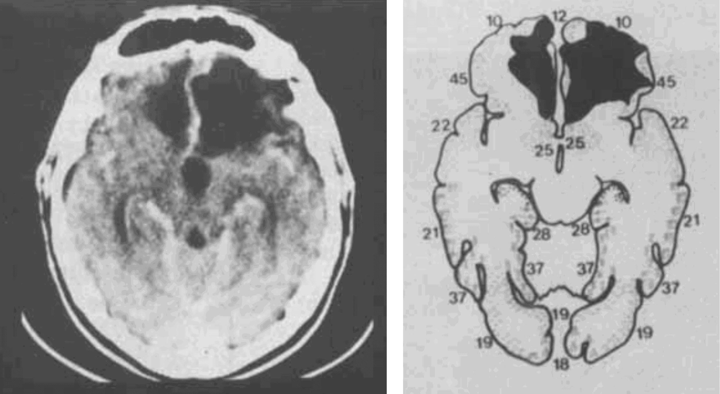 รูปรอยแผลในสมองส่วน vmPFC ของอีเลียต